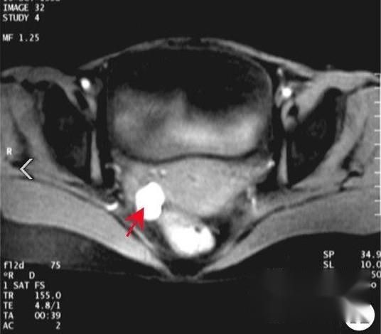 巧克力囊肿严重吗？